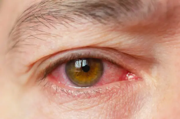 pink eye infection