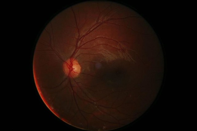 retinal damage 